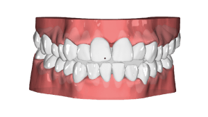 Clear Aligners For Teeth