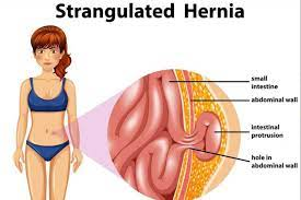Hernia Surgery Cost In Bangalore