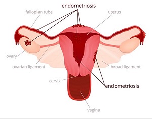 ayurveda curing endometriosis