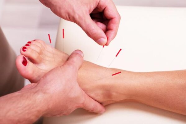 chronic pain acupuncture