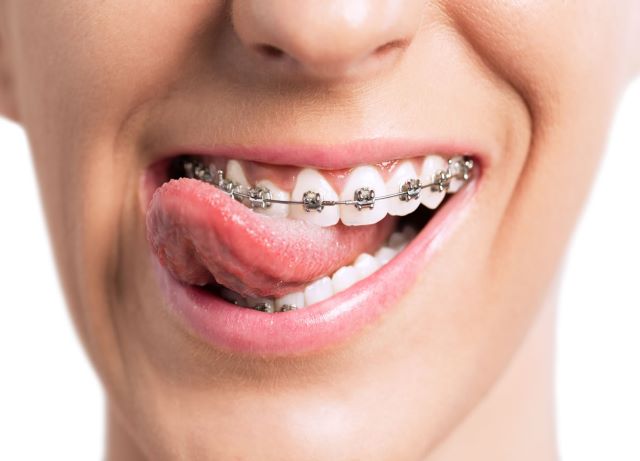 orthodotic braces