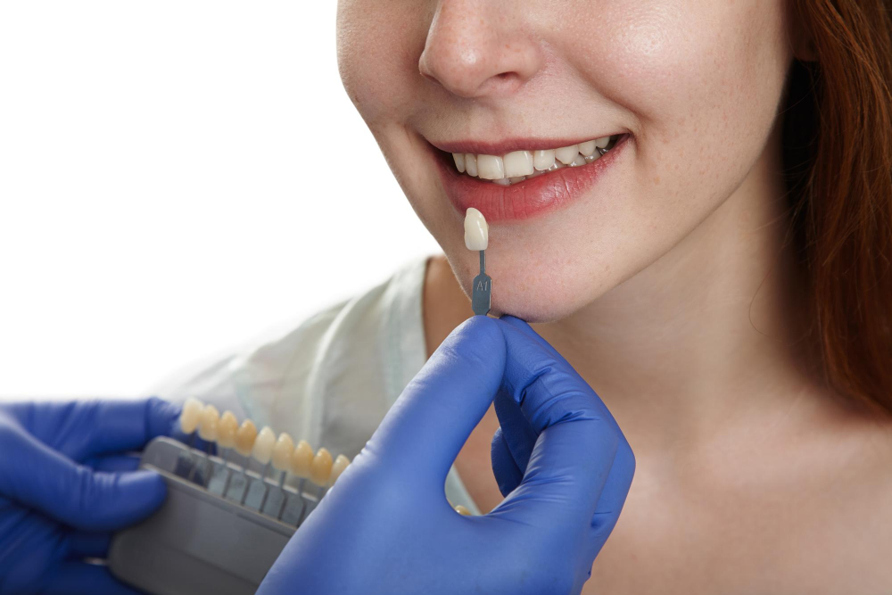 The Ultimate Guide to Maintaining Healthy Dental Veneers