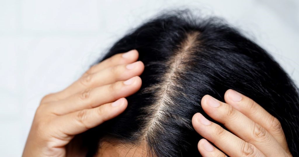 Alopecia Market