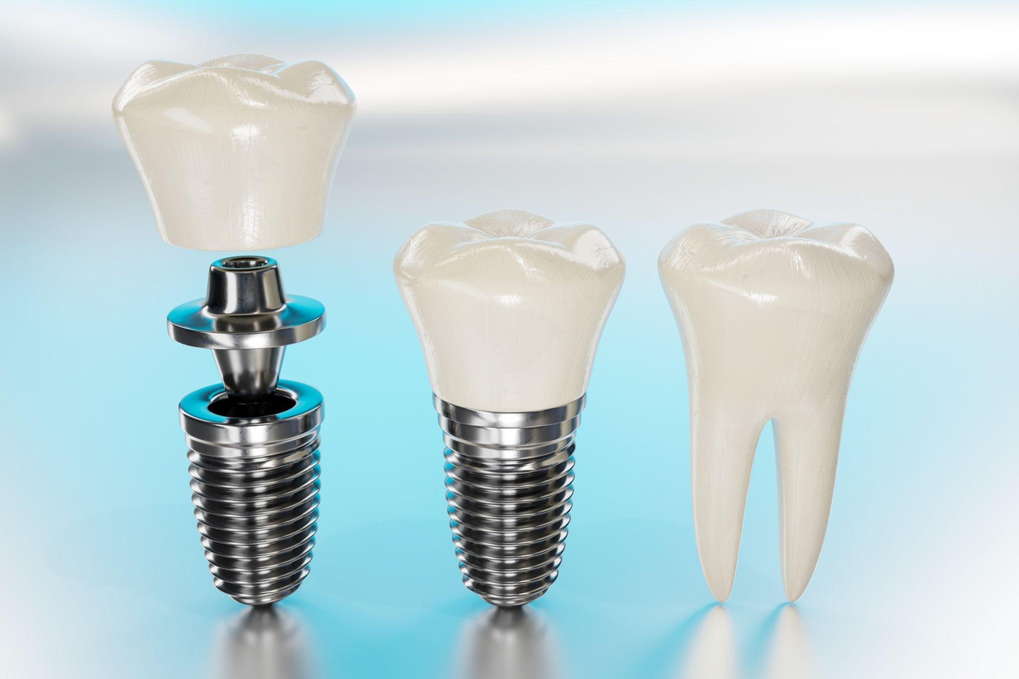 What Are the Benefits of Aberdeen's Best Dental Implants