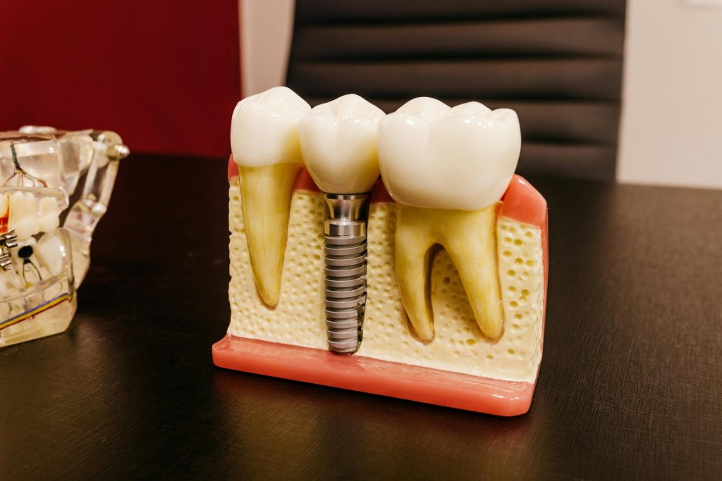 dental implants ryde