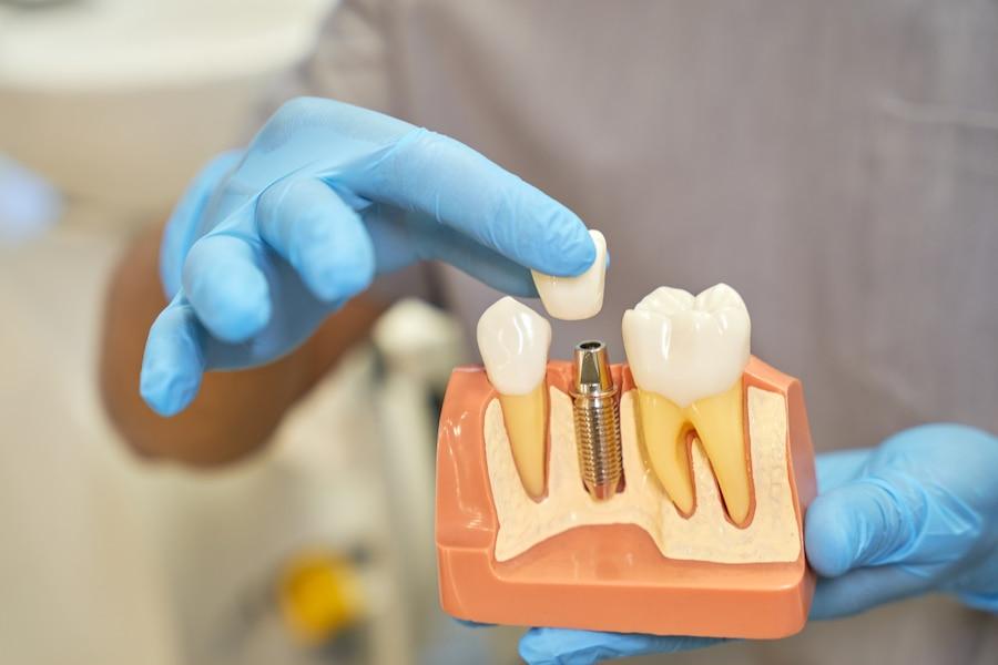 dental implants in california
