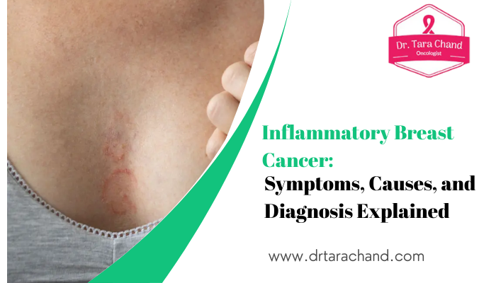 inflammatory breast cancer