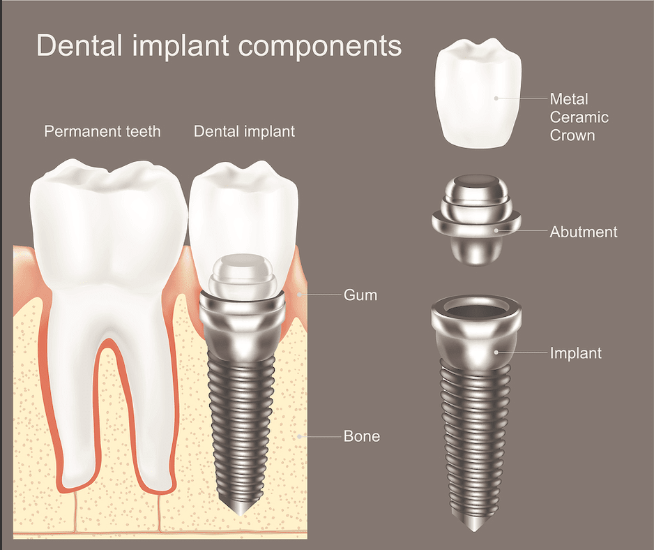 dental implant