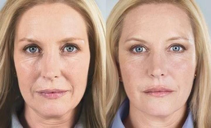 smile lines treatment at home