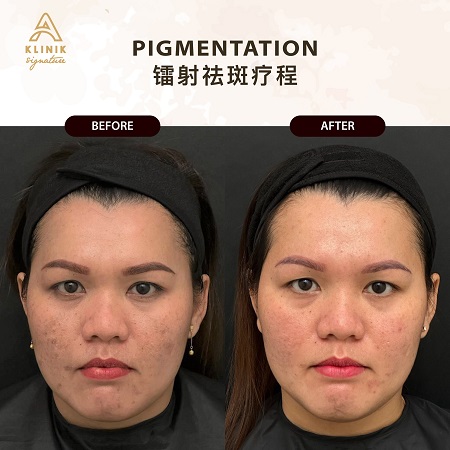 How to Choose the Right Skin Pigmentation Facial Treatment in Malaysia?